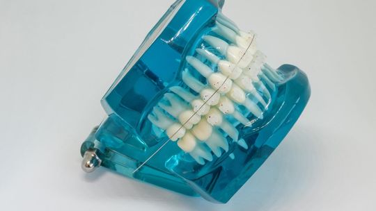 Innowacyjne metody odbudowy uzębienia przy użyciu implantów